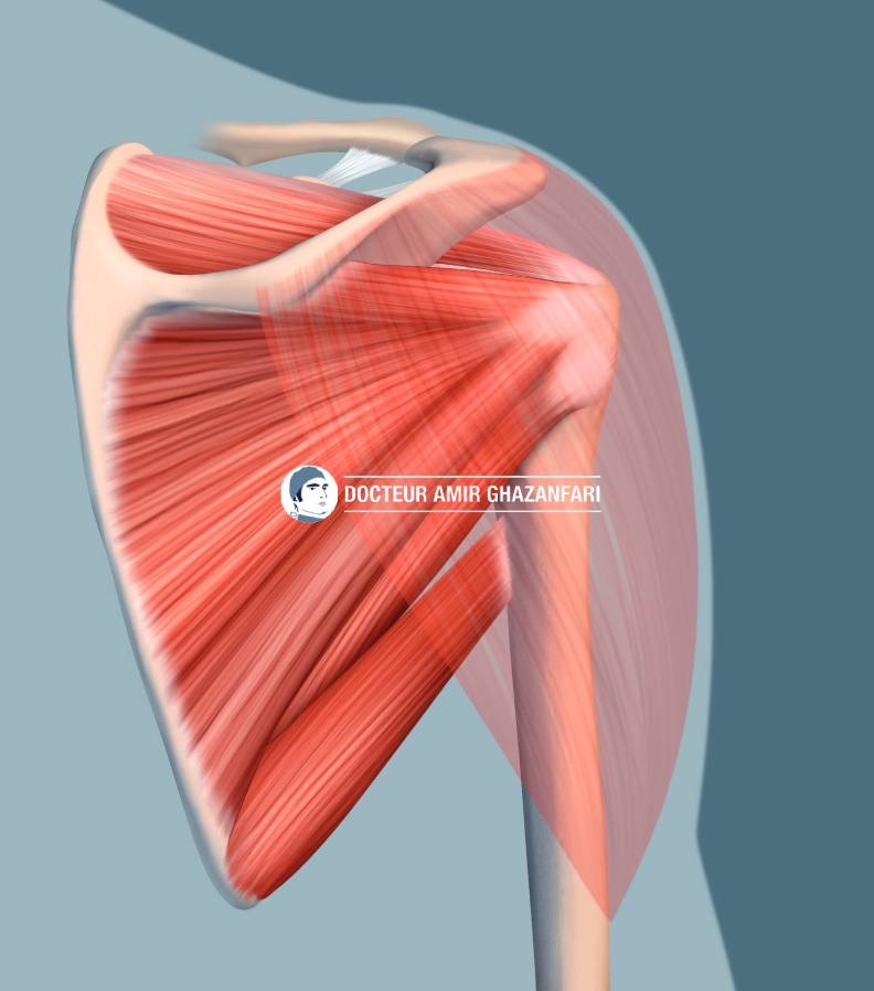Image 2 Prothèse d'épaule - Figure 2. Muscles de l'épaule: la coiffe des rotateurs (sous-scapulaire, supra-épineux, infra-épineux, petit rond), le muscle deltoïde et le muscle biceps brachial