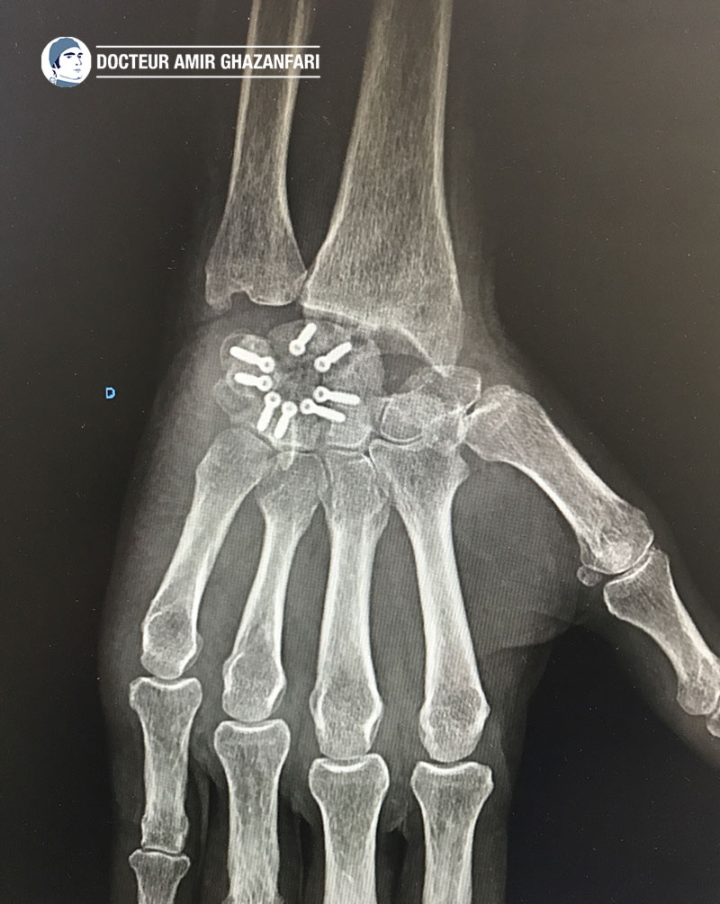 Arthrose du poignet - Figure 7. Résultat d'une scaphoïdectomie associée à une arthrodèse des quatre os