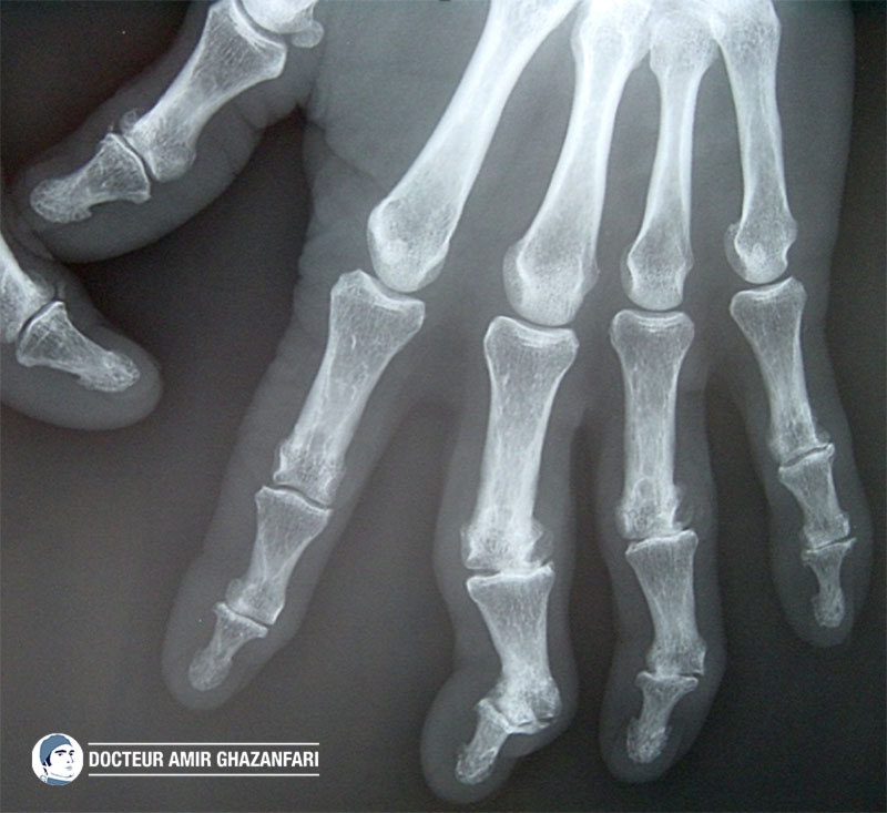 Arthrose des doigts - Figure 2. Radiographie d'une main arthrosique : signes cardinaux d'arthrose (pincements articulaires, géodes, condensation de l'os sous-chondral et ostéophytes) associés à des désaxations articulaires