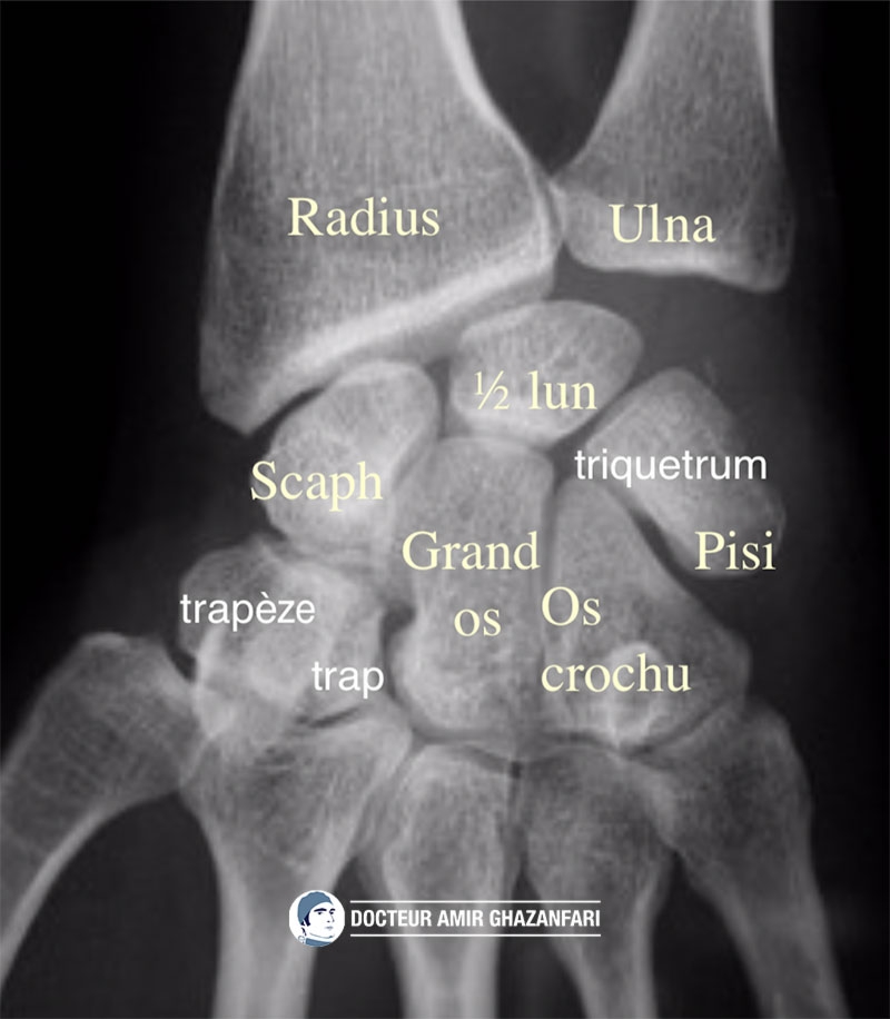 Fracture de scaphoïde - Figure 1. Anatomie des os du poignet