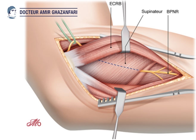 Epicondylite Laterale - Fgure 1. Anatomie de la face externe du coude.
