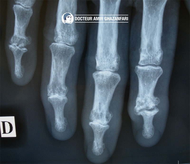 Kyste mucoîde - Figure 3. Importante arthrose au niveau des articulation inter-phalangiennes distales des doigts sur les clichés radiographiques