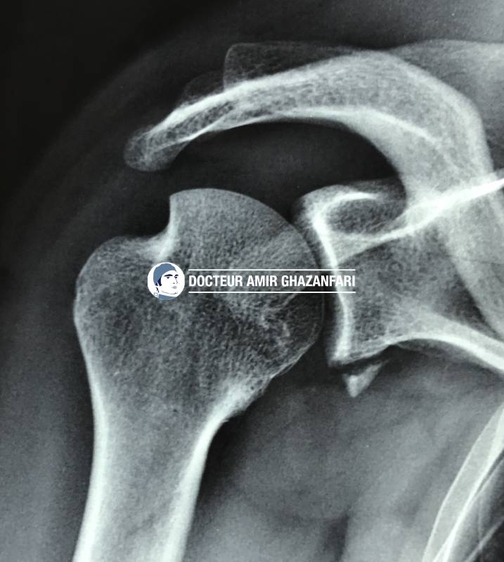Instabilité antérieure de l'épaule - Figure 8. Radiographies de l'épaule de face : encoche de la tête humérale associée à une fracture du bord antéro-inférieur de la glène, secondaires à une luxation antérieure de l'épaule