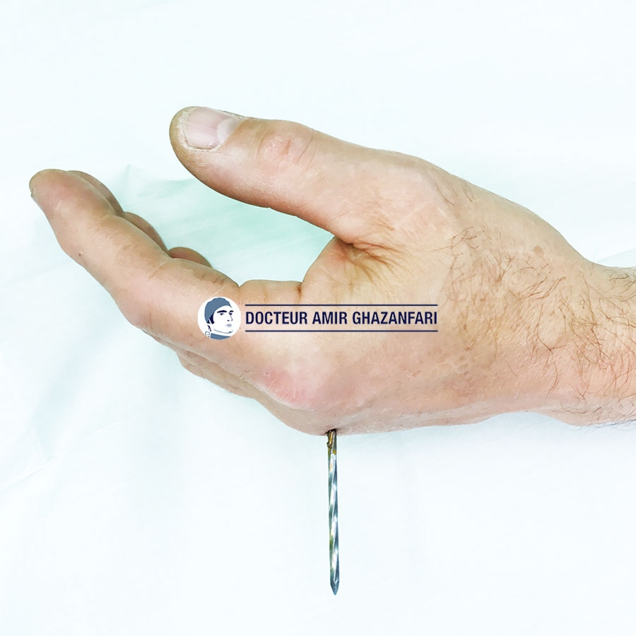 undefined - Plaie transfixiante de la main par corps étranger nécessitant une extraction au bloc opératoire