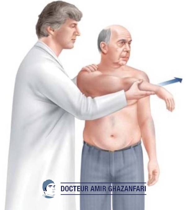 Arthrose acromio claviculaire - Figure 3. “Cross-Body Arm Test” déclenchant des douleurs au niveau de l'articulation acromio-claviculaire