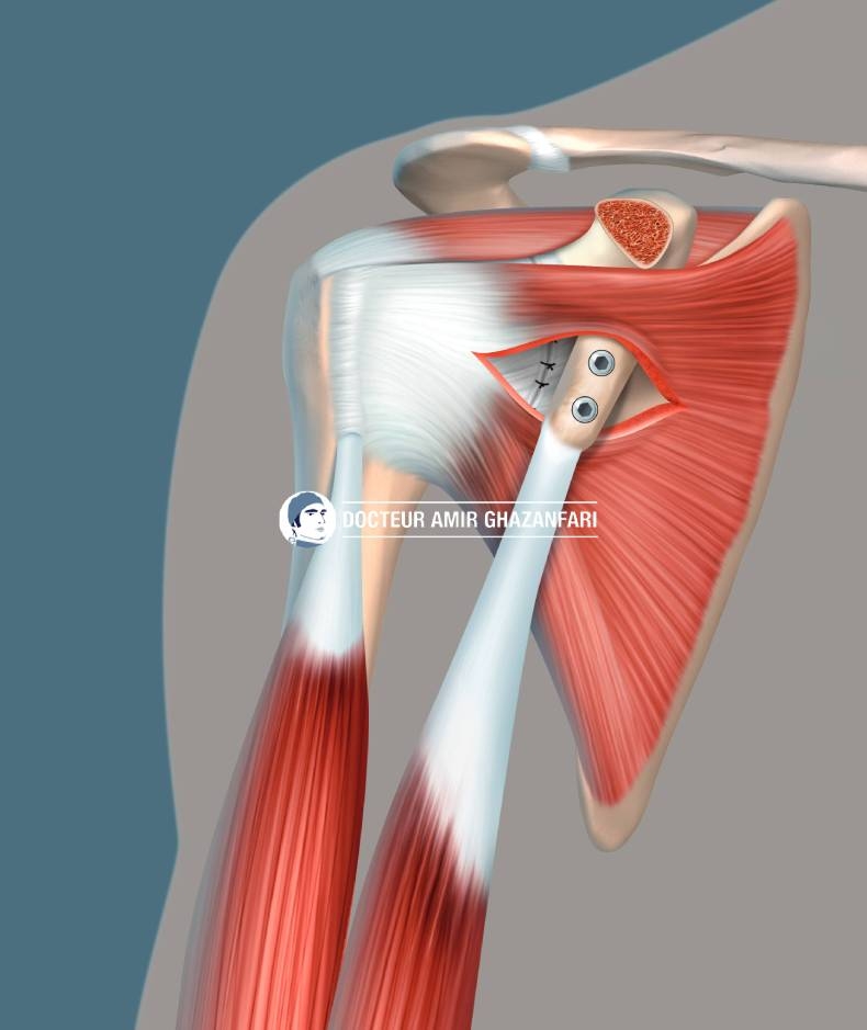 Image 1 Instabilité antérieure de l'épaule - Figure 10. Stabilisation chirurgicale de l'épaule par une butée osseuse selon Latarjet, prélevée sur la coracoïde