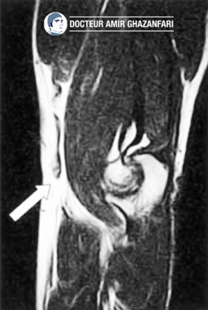 Rupture du tendon du biceps au coude - Figure 3. Cliché d'IRM montrant une rupture complète de l'insertion distale du biceps au coude (flèche blanche)