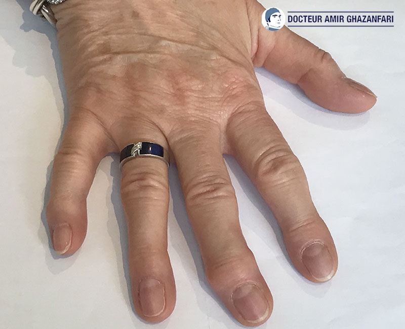 Arthrose des doigts - Figure 1. Arthrose de la main responsable de la déviation des doigts et de l'apparition de nodules digitaux