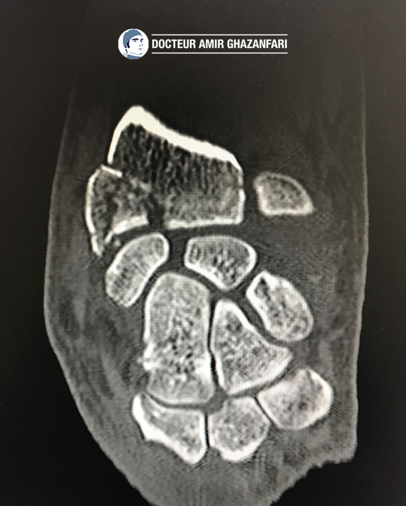 Image 1 Fracture du poignet - Figure 5. Scanner du poignet mettant en évidence une fracture articulaire du radius