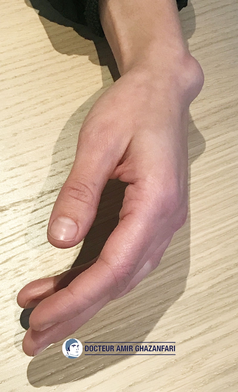 Image 2 Kyste du poignet - Figure 1. Volumineux kyste dorsal du poignet responsable d'une gêne esthétique et fonctionnelle