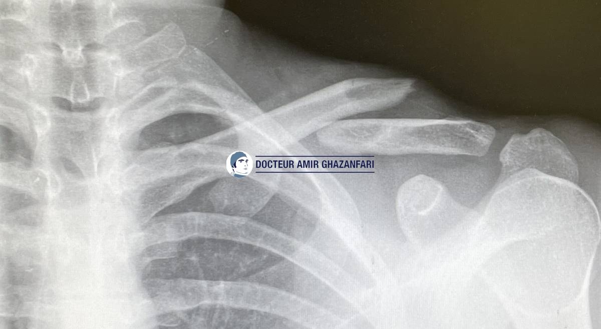 Fracture de clavicule - Figure 2. Radiographies de l'épaule: fracture déplacée de la clavicule