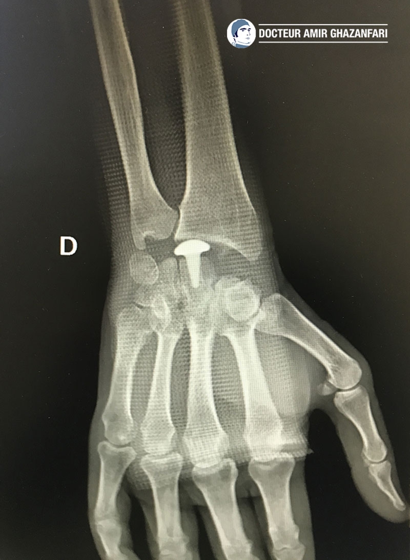 Image 2 Arthrose du poignet - Figure 5. Résection de première rangée du carpe avec implant de resurfaçage RCPI