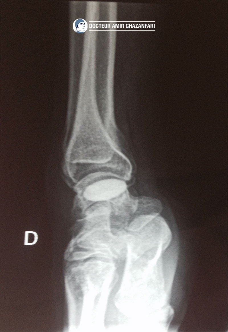 Image 2 Pseudoarthrose du scaphoïde - Figure 6. Implant scaphoïdien en pyrocarbone (APSI) mis en place dans le cadre d'une pseudarthrose proximale du scaphoïde