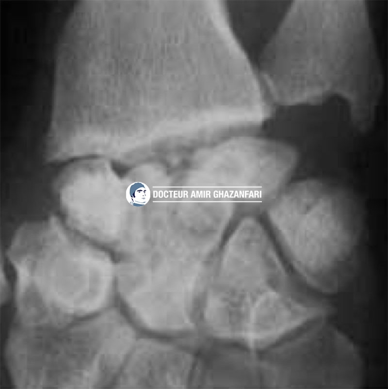 Fracture de scaphoïde - Figure 2. Destruction du poignet avec importante arthrose dans les suites d'une fracture négligée du scaphoïde