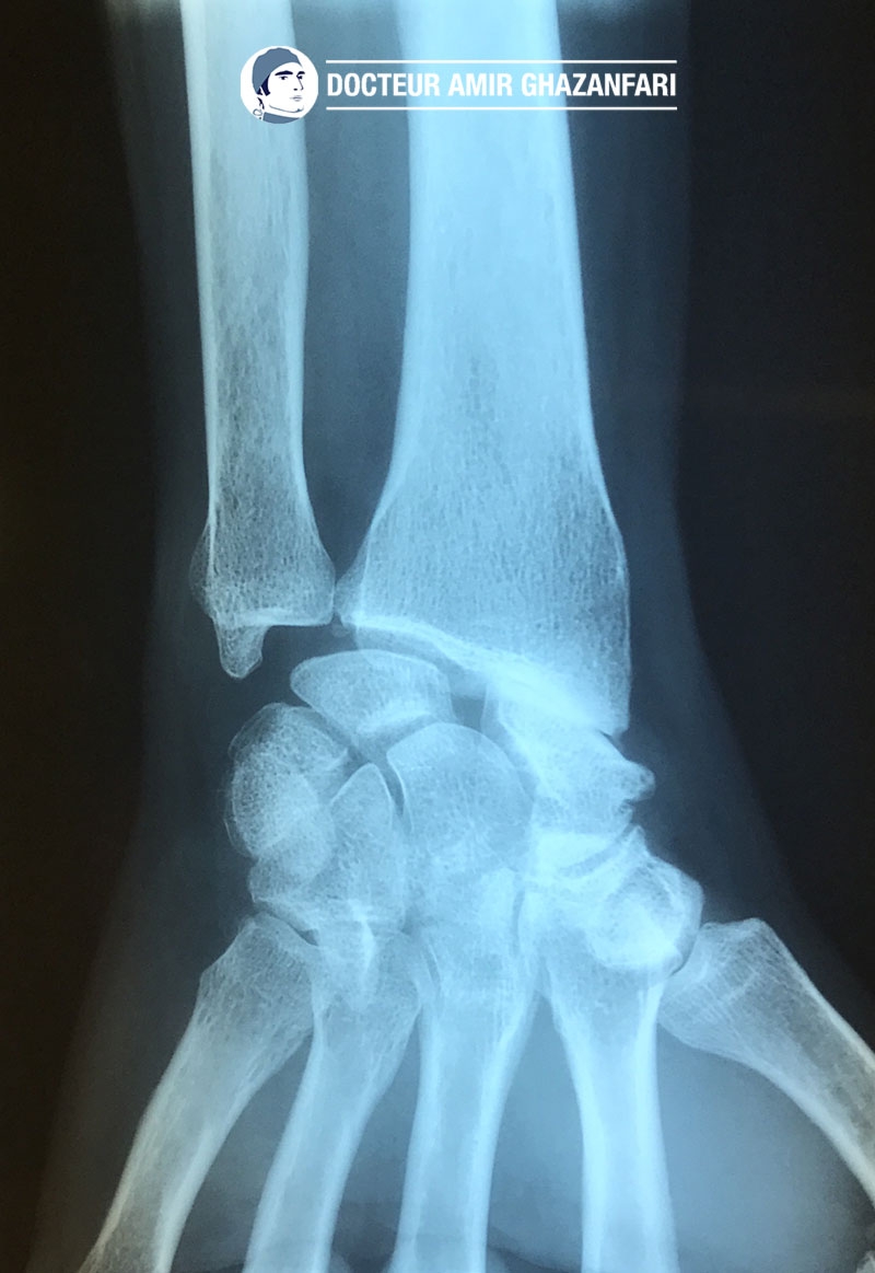 Arthrose du poignet - Figure 2. Séquelles de rupture du ligament  scapho-lunaire: apparition d'un diastasis (écart)  scapho-lunaire associé à une arthrose radio-scaphoidienne
