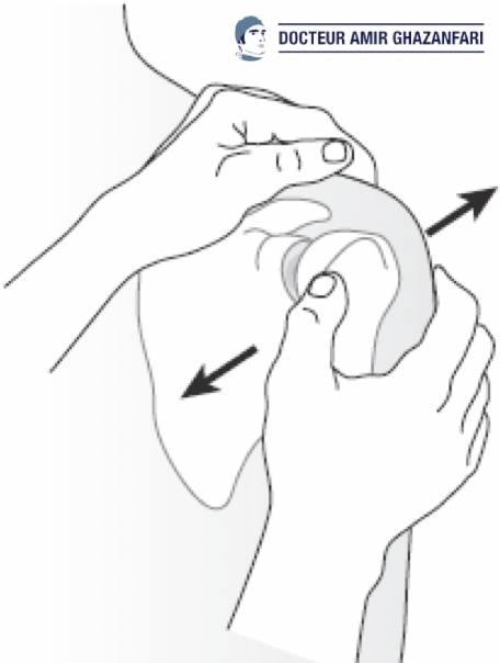 Instabilité antérieure de l'épaule - Figure 6. Tiroir gléno-huméral témoignant d'une hyperlaxité antéro-postérieure de l'épaule